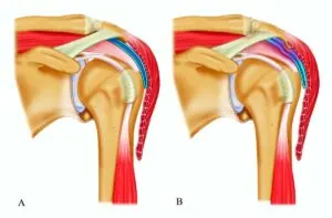Conflit Sous-Acromial