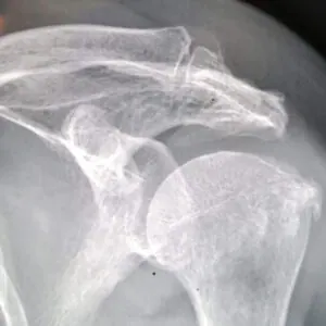 Arthrose Acromio-Claviculaire
